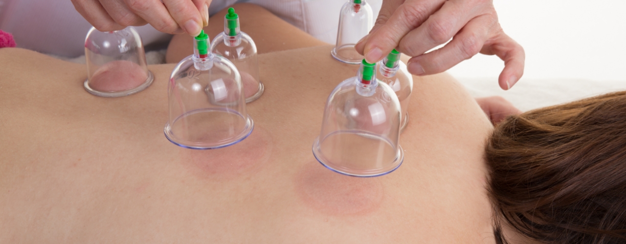 physiotherapy-center-cupping-sports-medicine-experts-dundas-on