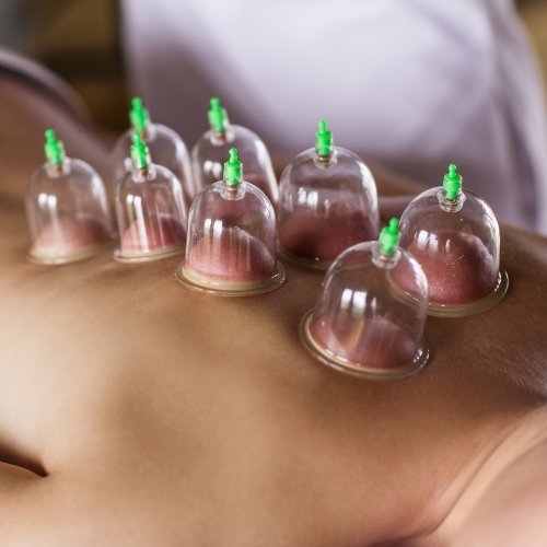 physiotherapy-center-cupping-sports-medicine-experts-dundas-on