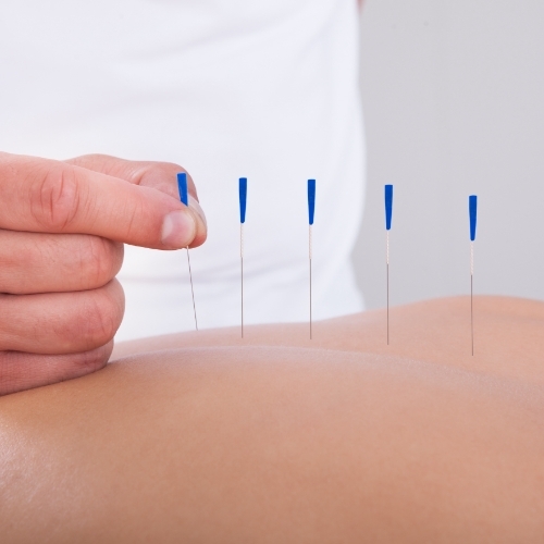 physiotherapy-center-dry-needling-sports-medicine-experts-dundas-on